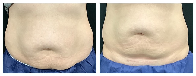 TruSculpt iD For The Flanks New York City - Manhattan - Carnegie Womens  Health