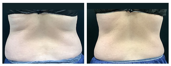 Flanks Liposuction  Before and After Photos - Palm Clinic